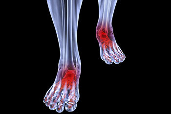 Arthritic foot care in the Riverside County, CA: Murrieta (Temecula, Menifee, Lake Elsinore, French Valley, Wildomar, Lakeland, Village, Canyon Lake, Valle De Los Caballos) areas