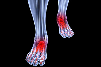 Arthritic foot care in the Riverside County, CA: Murrieta (Temecula, Menifee, Lake Elsinore, French Valley, Wildomar, Lakeland, Village, Canyon Lake, Valle De Los Caballos) areas