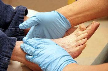 Diabetic foot treatment in the Riverside County, CA: Murrieta (Temecula, Menifee, Lake Elsinore, French Valley, Wildomar, Lakeland, Village, Canyon Lake, Valle De Los Caballos) areas