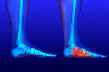 Flat feet in the Riverside County, CA: Murrieta (Temecula, Menifee, Lake Elsinore, French Valley, Wildomar, Lakeland, Village, Canyon Lake, Valle De Los Caballos) areas