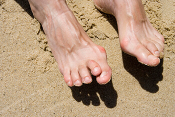 Hammertoe treatment in the Riverside County, CA: Murrieta (Temecula, Menifee, Lake Elsinore, French Valley, Wildomar, Lakeland, Village, Canyon Lake, Valle De Los Caballos) areas