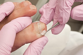 Ingrown toenail treatment in the Riverside County, CA: Murrieta (Temecula, Menifee, Lake Elsinore, French Valley, Wildomar, Lakeland, Village, Canyon Lake, Valle De Los Caballos) areas