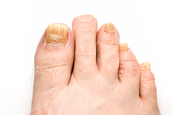 Toenail fungus treatment in the Riverside County, CA: Murrieta (Temecula, Menifee, Lake Elsinore, French Valley, Wildomar, Lakeland, Village, Canyon Lake, Valle De Los Caballos) areas