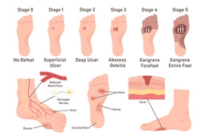 Stages of Pressure Ulcers and How to Care for Them