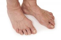 Rheumatoid Arthritis and Feet